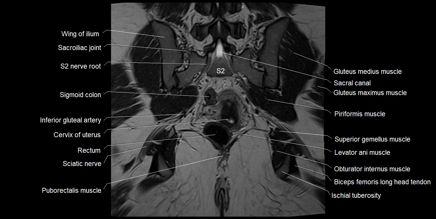 female pelvis coronal cross sectional anatomy image 27.webp
